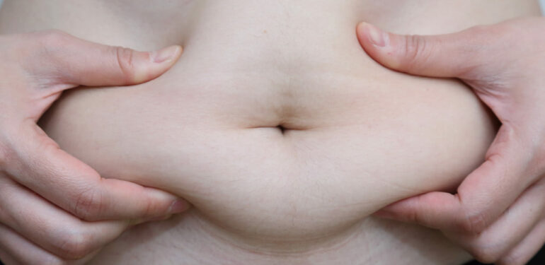 Quel Est L Interet De L Abdominoplastie Chez Un Patient Obese